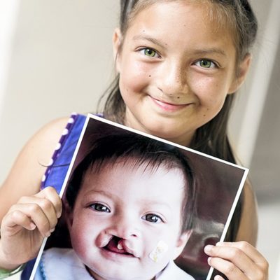 Young girl poses with a picture of her younger self prior to surgery