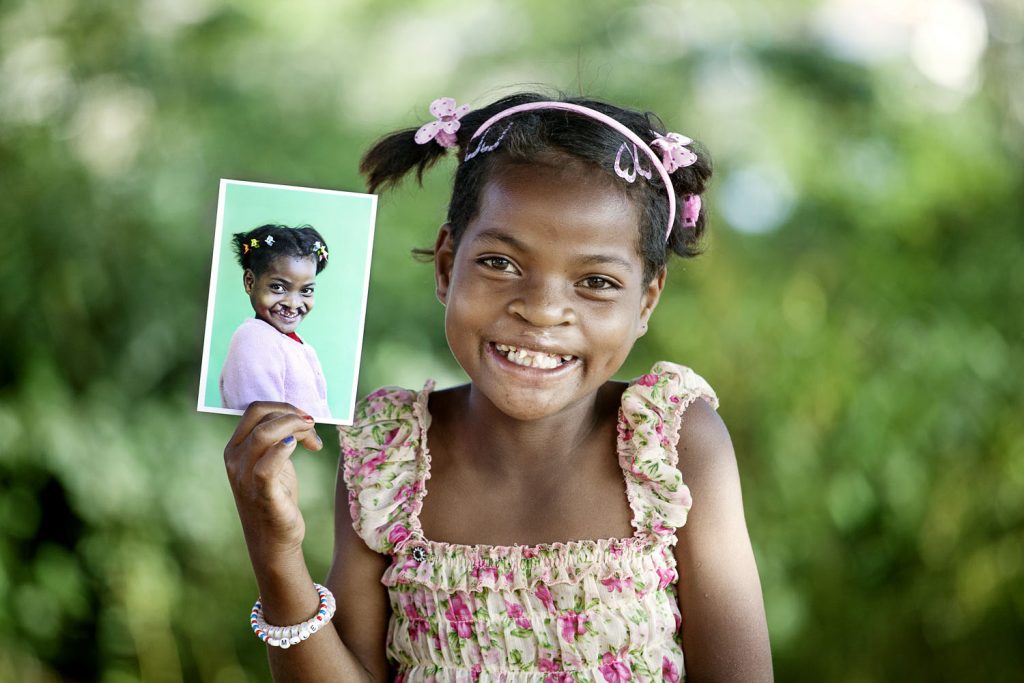 Young girl smiles and holds photo of herself before she had a surgery to repair a cleft lip