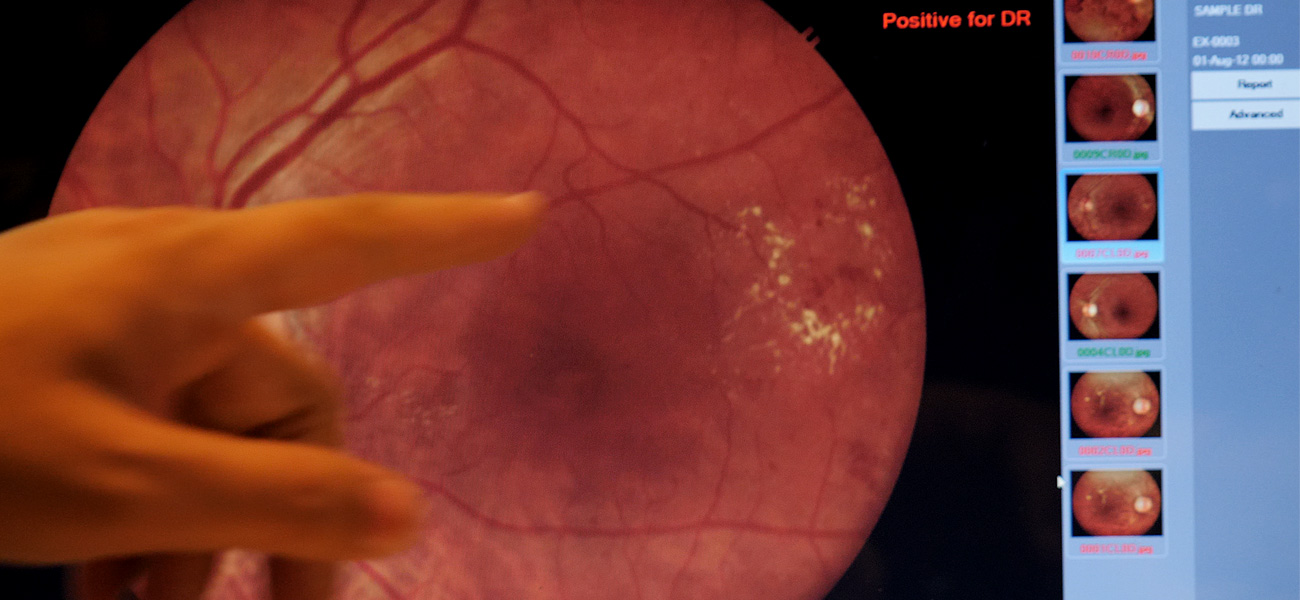An image of an eye fundus that has been graded positive for diabetic retinopathy.